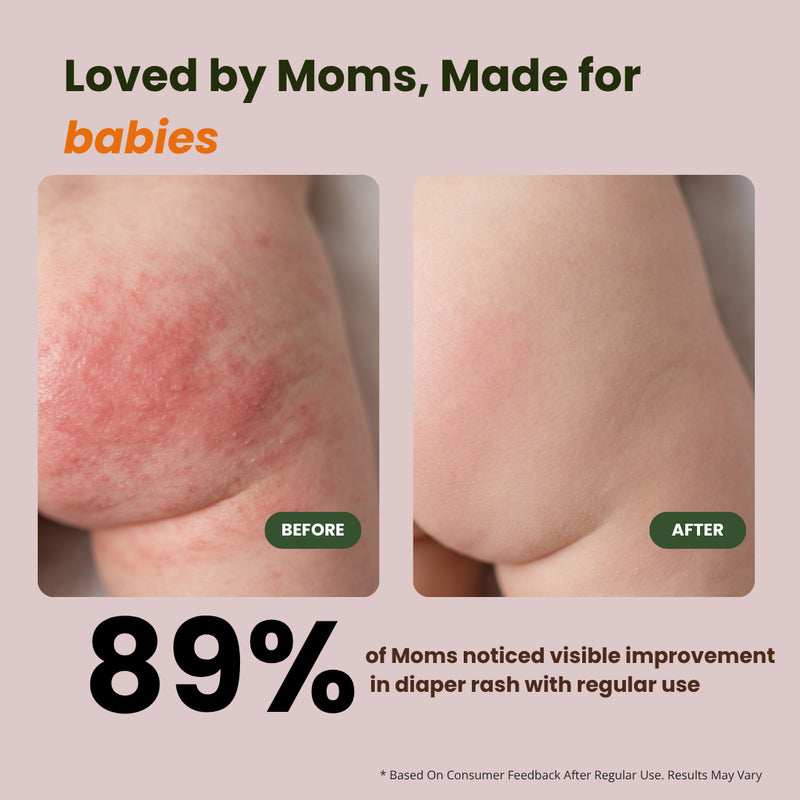 Diaper Rash Cream for Babies